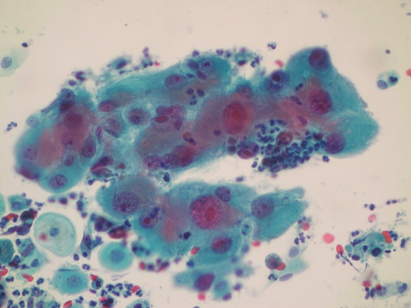 Nieprawidłowe komórki gruczołowe – komórki rakowe endometrioidalne