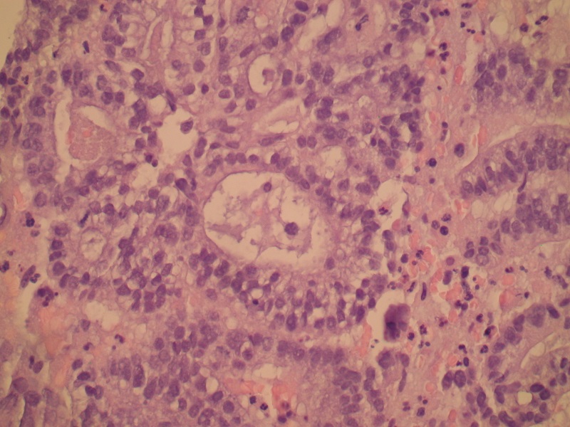 Rak gruczołowy jasnokomórkowy (G-3) endometrioidny