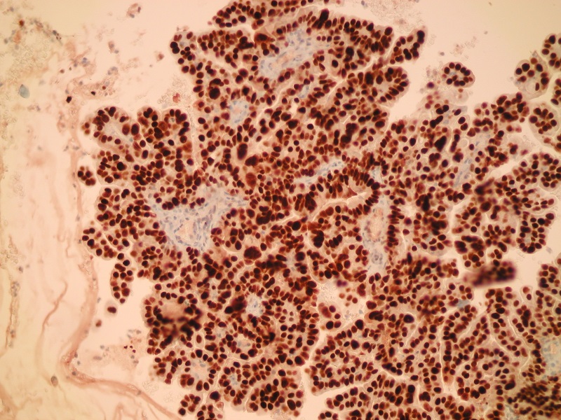 Rak gruczołowy jasnokomórkowy (G-3) endometrioidny – bardzo silna ekspresja białka p53