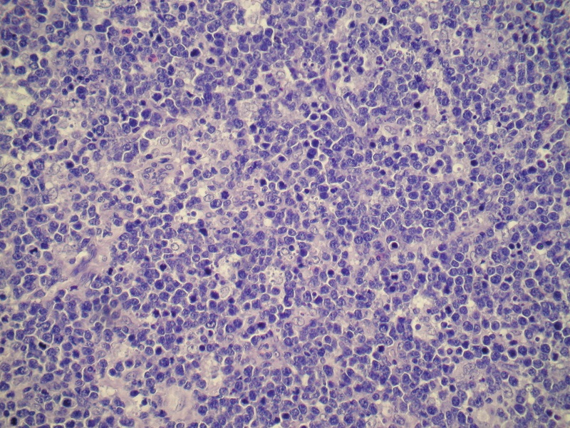 Atypowe nowotworowe limfocyty