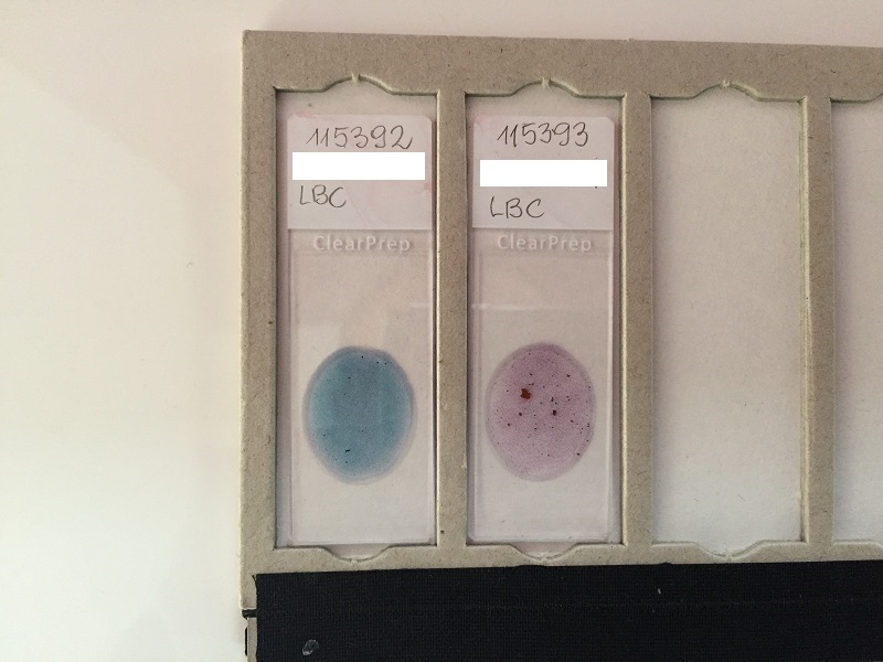 Cytologia szyjki macicy na podłożu płynnym LBC ClearPrep® – preparaty cytologiczne