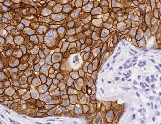 Barwienie immunohistochemiczne receptora HER2 w raku piersi