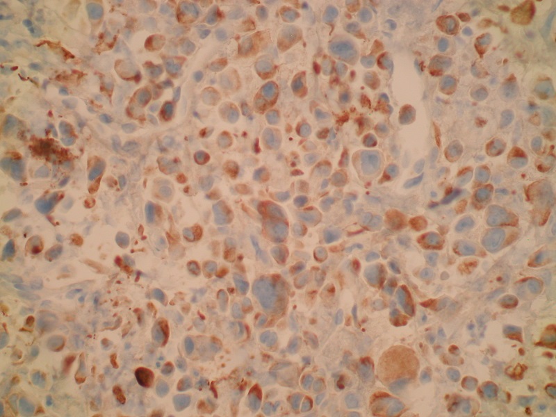 Mięsakorak płuca – pozytywne barwienie immunohistochemiczne CK[AE1/AE3] (obiektyw 40x)