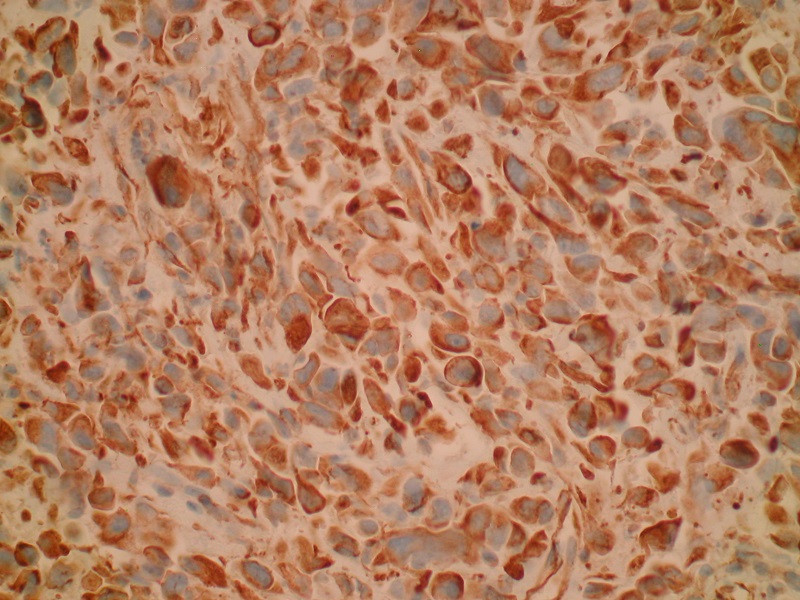 Mięsakorak płuca – pozytywne barwienie immunohistochemiczne vimentyną (obiektyw 40x)
