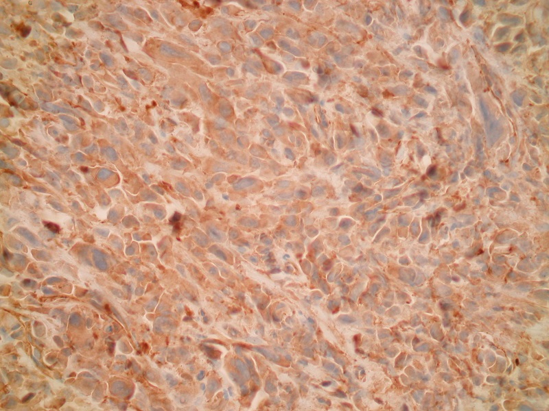 Mięsakorak płuca – pozytywne barwienie immunohistochemiczne białka S-100 (obiektyw 40x)