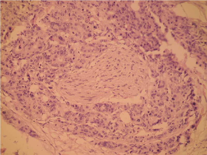 Rak jelita grubego – obraz mikroskopowy