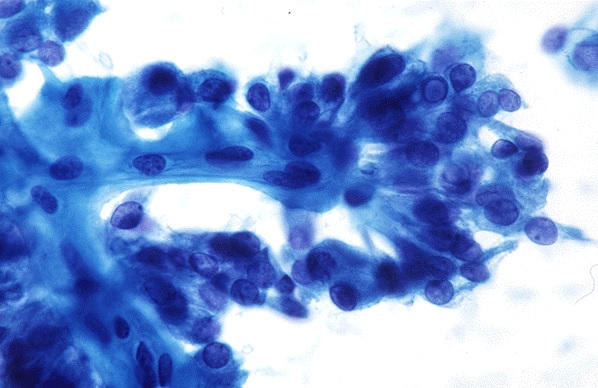 Obraz cytologiczny raka brodawkowatego tarczycy