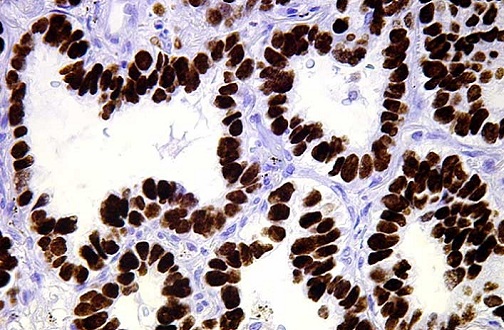 Barwienie immunohistochemiczne TTF-1 w raku gruczołowym płuca