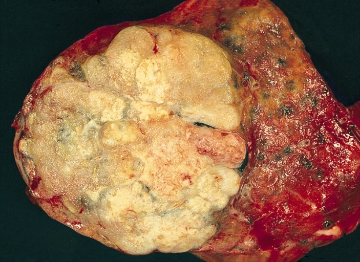 Rak gruczołowy płuca – obraz makroskopowy (lobektomia)