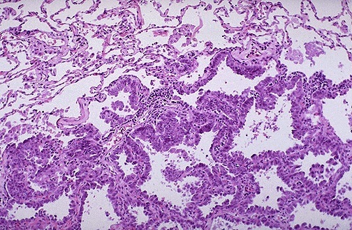 Rak gruczołowy płuca – obraz mikroskopowy