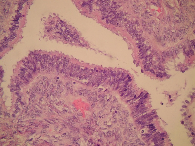 Rak surowiczy jajnika o dużym stopniu złośliwości (high-grade) - obraz mikroskopowy