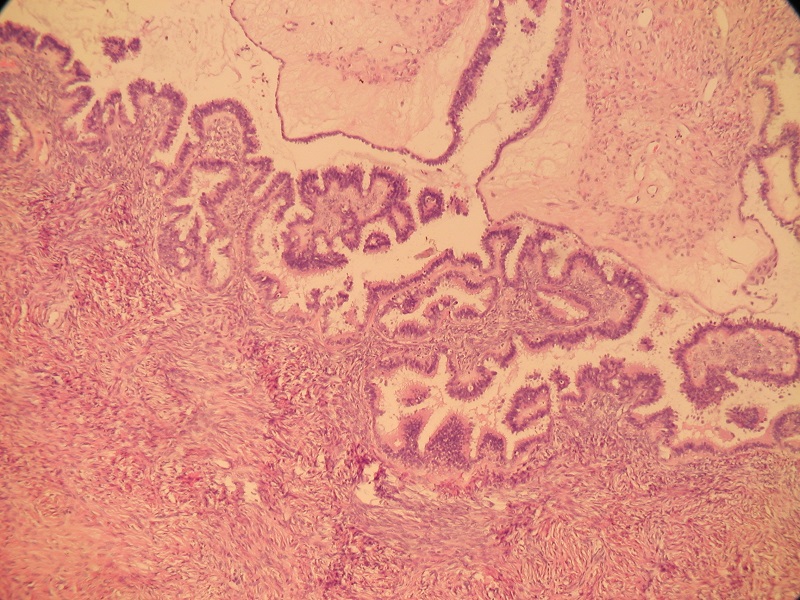 Rak surowiczy jajnika – obraz mikroskopowy (obiektyw 4x)
