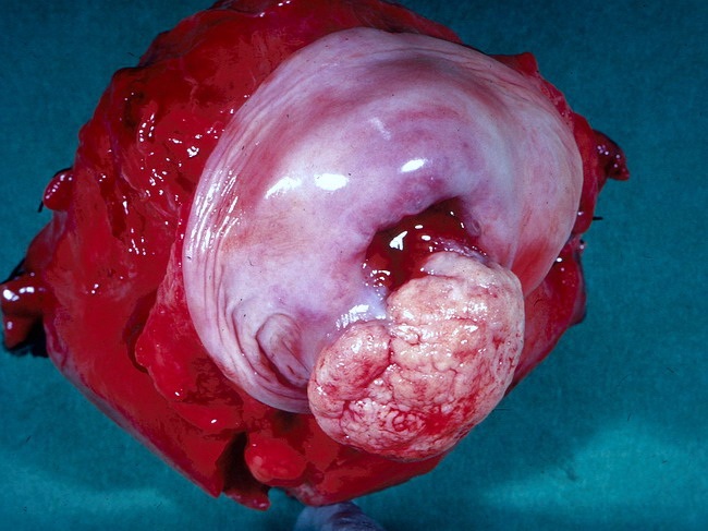 Rak szyjki macicy - postać egzofityczna