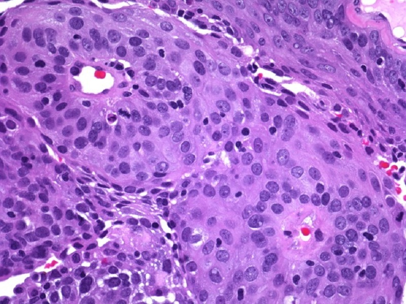 Rak płaskonabłonkowy szyjki macicy – obraz mikroskopowy