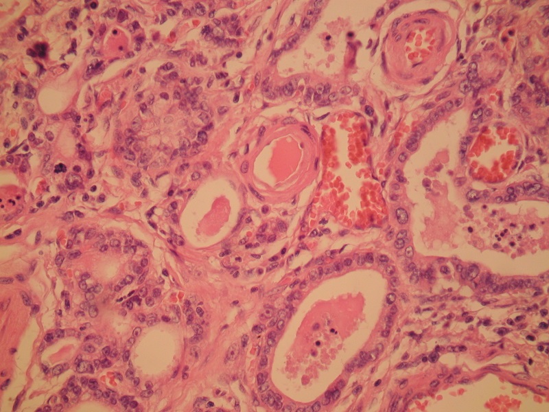 Rak gruczołowy żołądka G-1 – typ jelitowy 