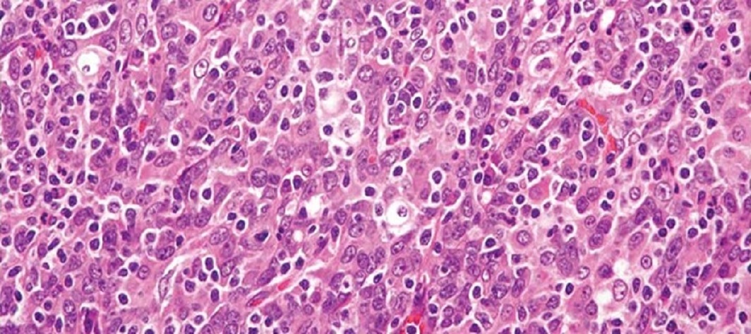 Rak żołądka z towarzyszącą infekcją EBV