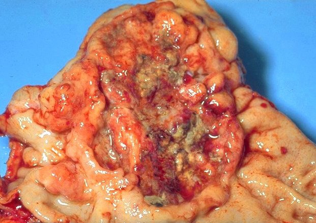 Rak żołądka - obraz makroskopowy