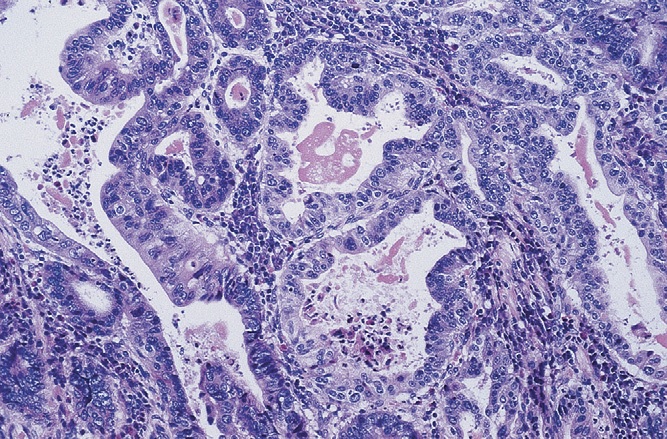 Rak żołądka - obraz mikroskopowy