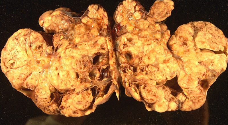 Rak jajnika - obraz makroskopowy