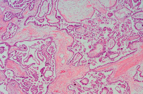 Rak surowiczy jajnika – obraz mikroskopowy