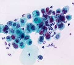 Zmiany śródnabłonkowe dużego stopnia HSIL (high-grade squamous intraepithelial lesion)