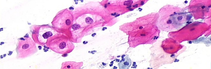 Koilocyty, zmiany śródnabłonkowe niskiego stopnia LSIL (low-grade squamous intraepitlelial lesion)