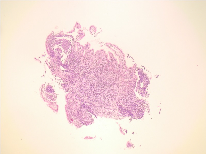 Choroba Alicji - obraz mikroskopowy