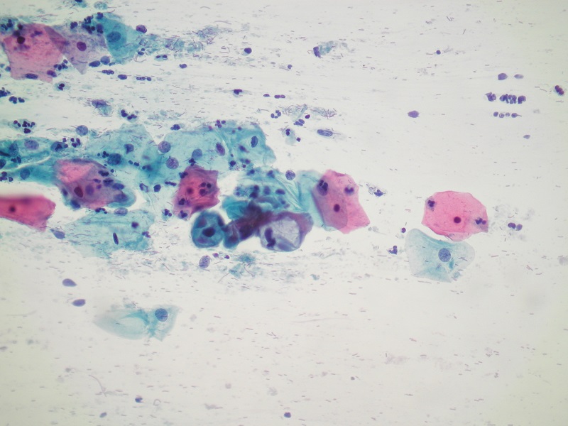 Mikroskopowy obraz rozmazu cytologicznego konwencjonalnego – komórki z cechami infekcji HPV