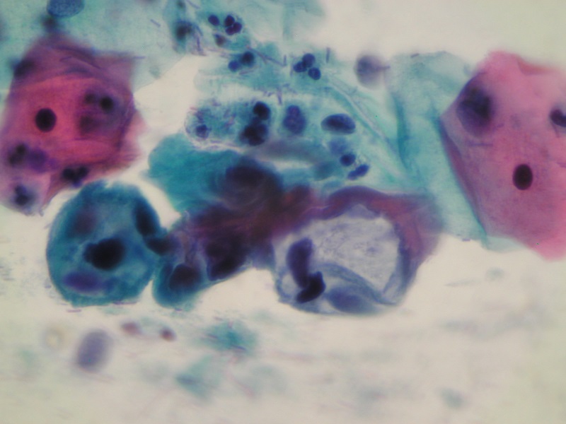 Mikroskopowy obraz rozmazu cytologicznego konwencjonalnego – komórki z cechami infekcji HPV
