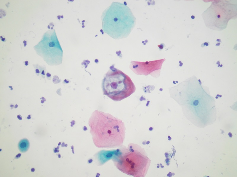 Obraz koilocyta w cytologii na podłożu płynnym (metoda ClearPrep®)
