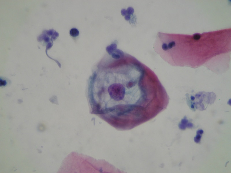 Obraz koilocyta w cytologii na podłożu płynnym (metoda ClearPrep®)