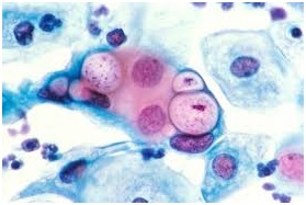 Obraz mikroskopowy Chlamydia trachomatis (badanie cytologiczne szyjki macicy)