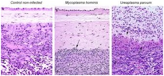 Obraz histopatologiczny infekcji Mycoplasma i Ureaplasma
