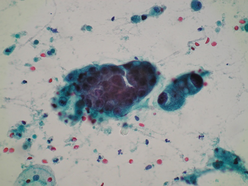 Nieprawidłowe komórki gruczołowe – komórki rakowe – barwienie Papanicolau (obiektyw 40x)