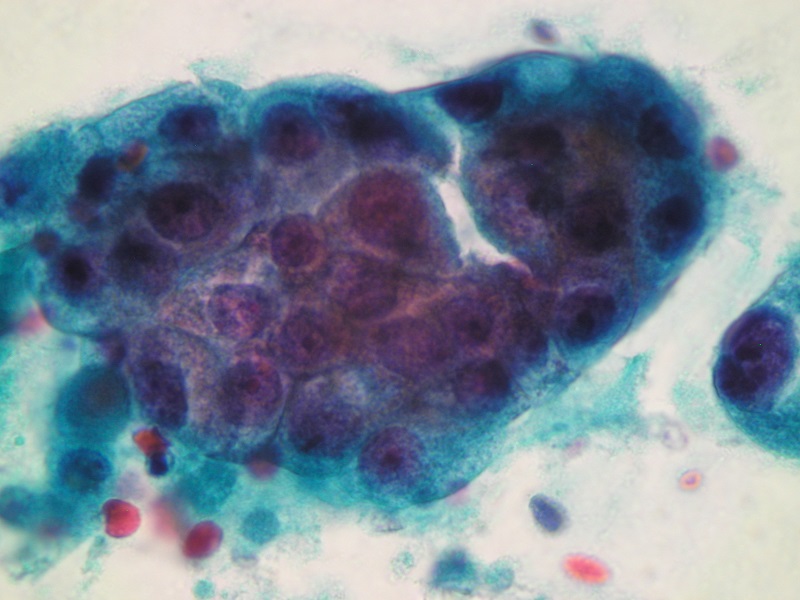 Nieprawidłowe komórki gruczołowe – komórki rakowe – barwienie Papanicolau (obiektyw 100x