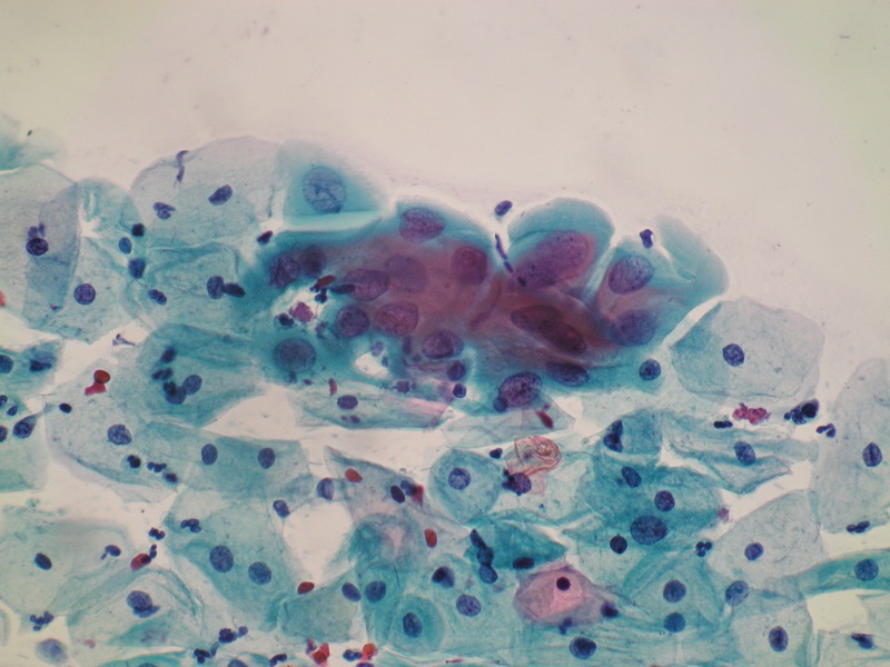 Nieprawidłowe komórki nabłonkowe ASC-H (obiektyw 40x)