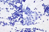 Obraz mikroskopowy niedrobnokomórkowego raka płuca