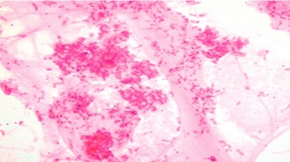 Obraz mikroskopowy wymazu szczoteczkowego; widoczne są liczne, rozproszone nabłonki oskrzelowe oraz skupienia komórek śluzowych