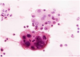 Obok prawidłowych komórek międzybłonka, grupa komórek nowotworowych