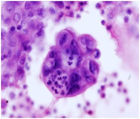 Grupa komórek nowotworowych, widoczna leukofagocytoza
