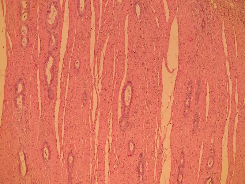 Rak gruczołowy jelita cienkiego – naciek błony mięśniowej właściwej – barwienie H+E (obiektyw 10x)