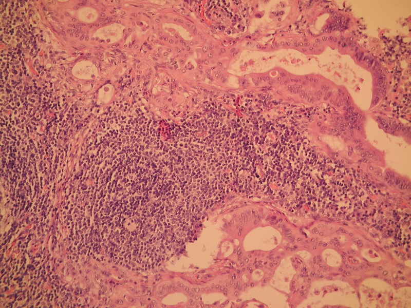 Rak gruczołowy jelita cienkiego – przerzut raka do węzła chłonnego – barwienie H+E (obiektyw 20x)
