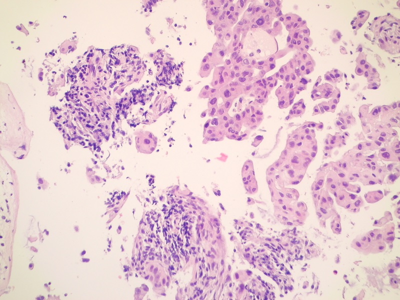 Rak gruczołowy płuca – obraz mikroskopowy (barwienie H+E)