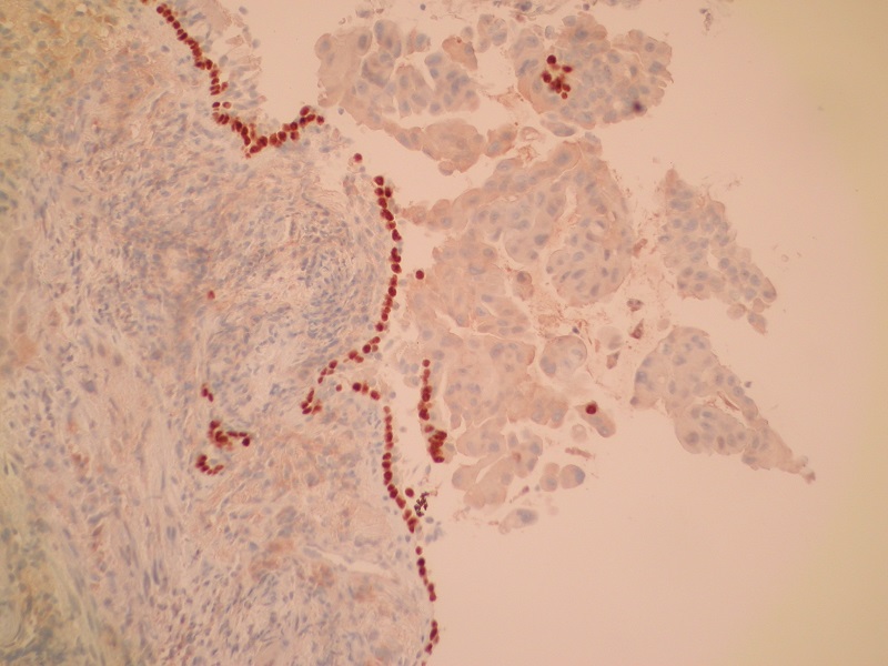 Rak gruczołowy płuca – obraz mikroskopowy (ujemna immunohistochemiczna ekspresja białka p40)