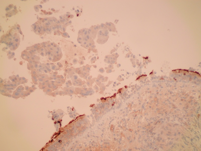 Rak gruczołowy płuca – obraz mikroskopowy (ujemna immunohistochemiczna ekspresja CD56)