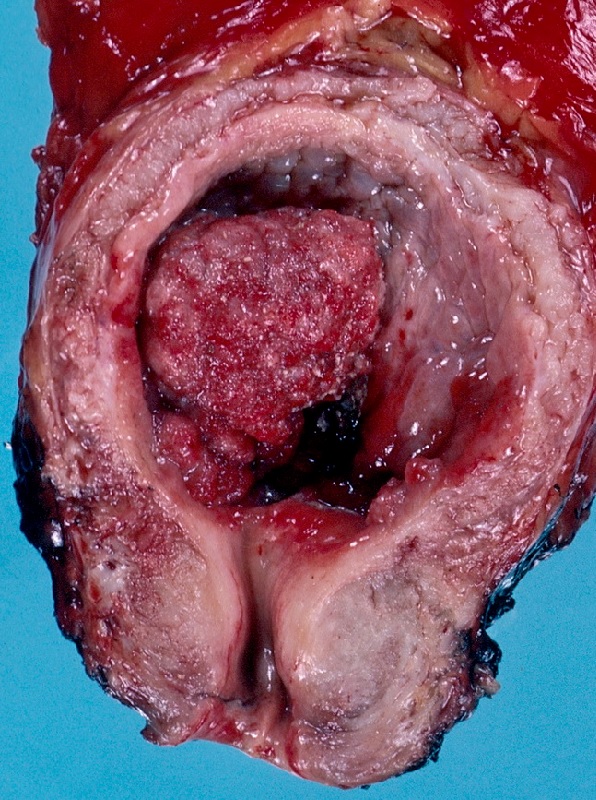 Rak pęcherza moczowego – obraz makroskopowy