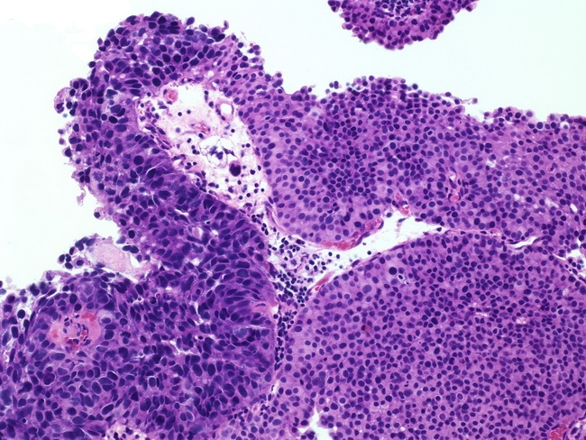 Rak pęcherza moczowego (Papillary urothelial carcinoma high-grade) – obraz mikroskopowy