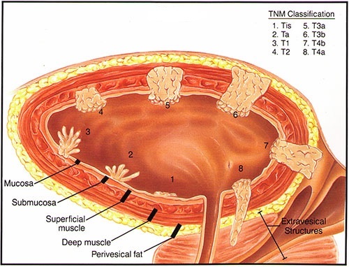System klasyfikacji TNM raka pęcherza moczowego
