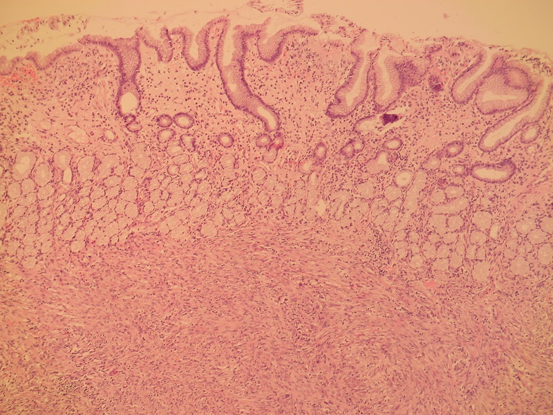 W górnej części zdjęcia błona śluzowa żołądka, a pod nią utkanie mięśniakomięsaka gładkomórkowego – barwienie H+E