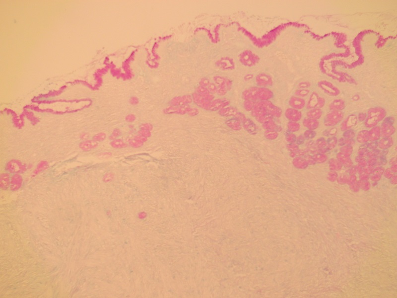 W górnej części zdjęcia błona śluzowa żołądka, a pod nią utkanie mięśniakomięsaka gładkomórkowego – barwienie histochemiczne paS-Alcjan blue
